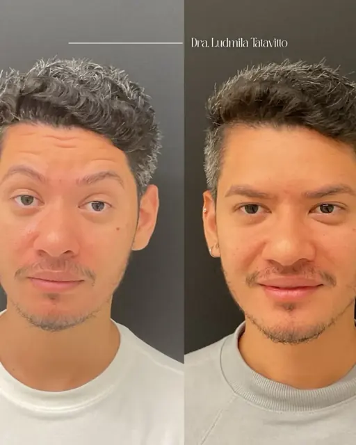 Antes e depois de harmonização facial masculina, vista frontal