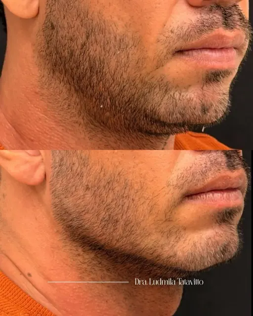 Antes e depois de contorno de mandíbula em paciente homem, vista de perfil